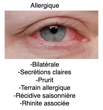 conjonctivite-allergique