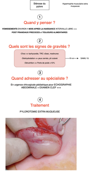 Conduite à tenir en cas de sténose du pylore