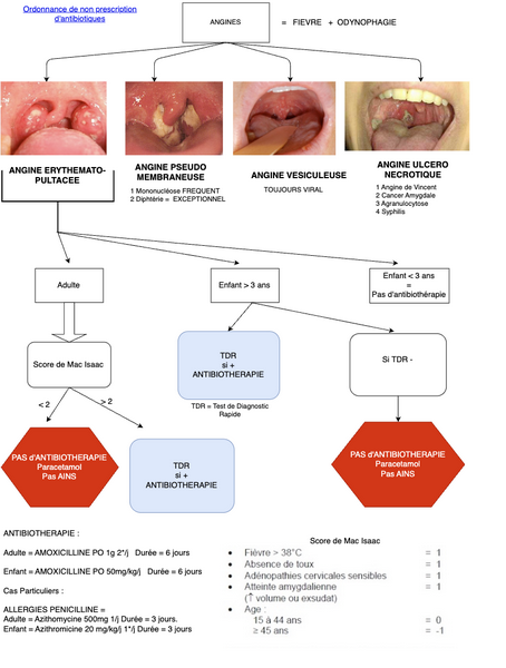 Conduite à tenir en cas d'Angines