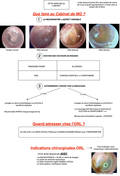 Conduite à tenir en cas d'Otite séreuse de l’enfant