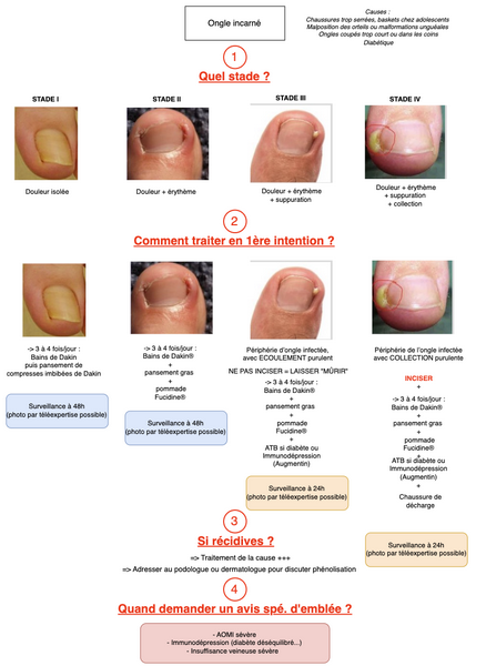 Ongle incarné