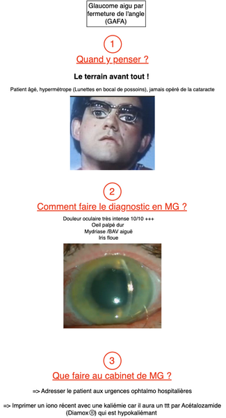 Glaucome aigu par fermeture de l'angle
