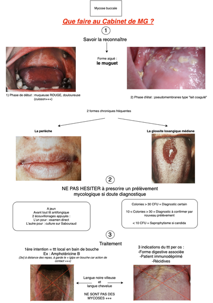 Conduite à tenir en cas de Mycose buccale 